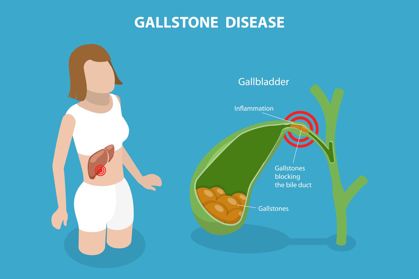 Gastroenterologist consultation for gallbladder stones and gallstone treatment