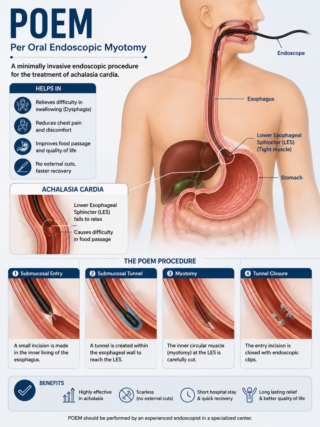 POEM Procedure for Achalasia Cardia